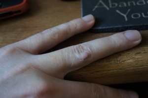 SONY DSC Finger Healed