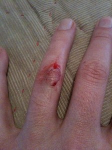 Finger Hacked Finger Scalped